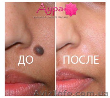 Удаление родинок, папиллом, бородавок, кератом, моллюска радиоволнами       - <ro>Изображение</ro><ru>Изображение</ru> #1, <ru>Объявление</ru> #1442922